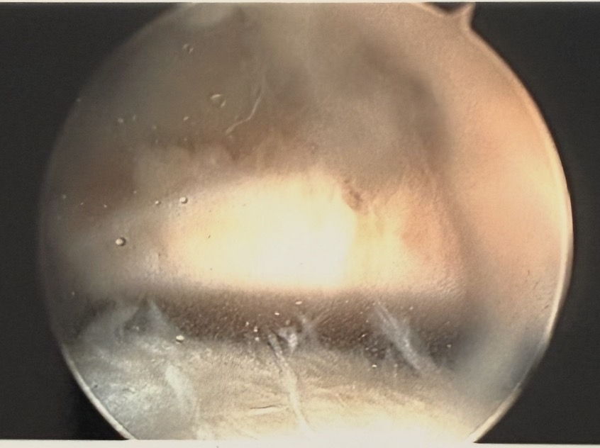 Arthroscopic view of an osteochondral defect of the knee