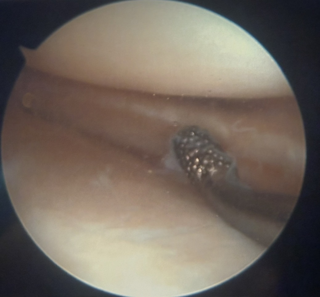 Arthroscopic assessment of the meniscus