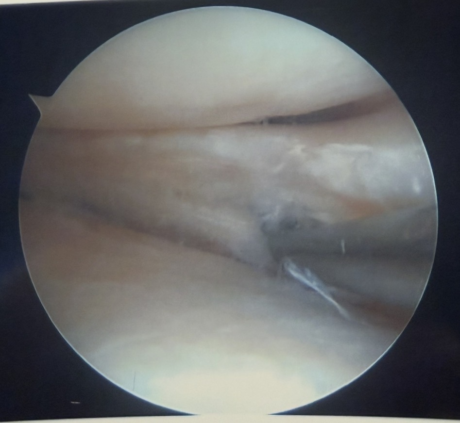Arthroscopic view during meniscal surgery