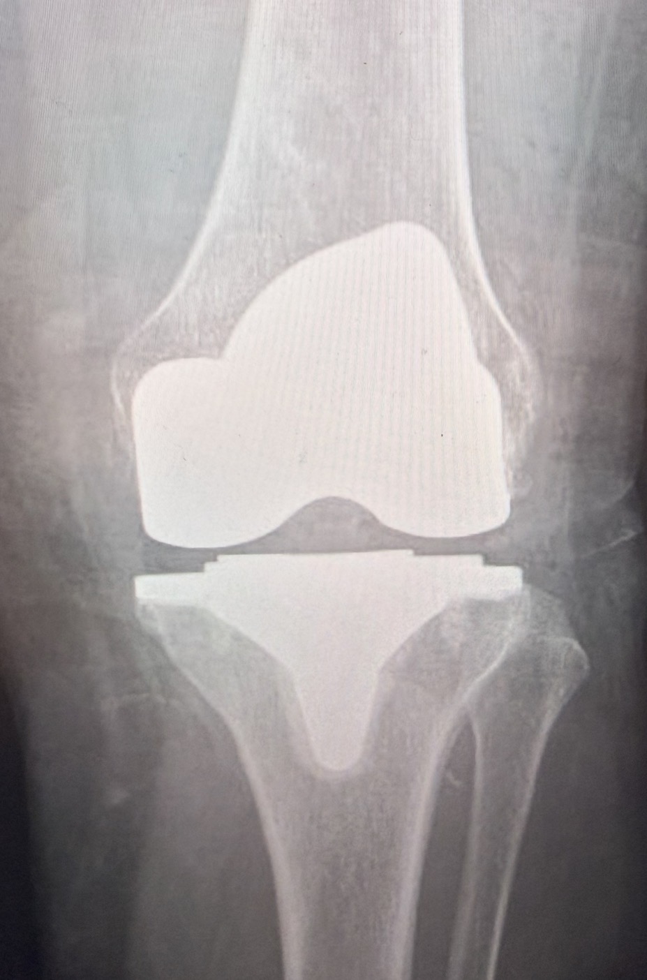 X-ray of a total knee replacement (A-P view)