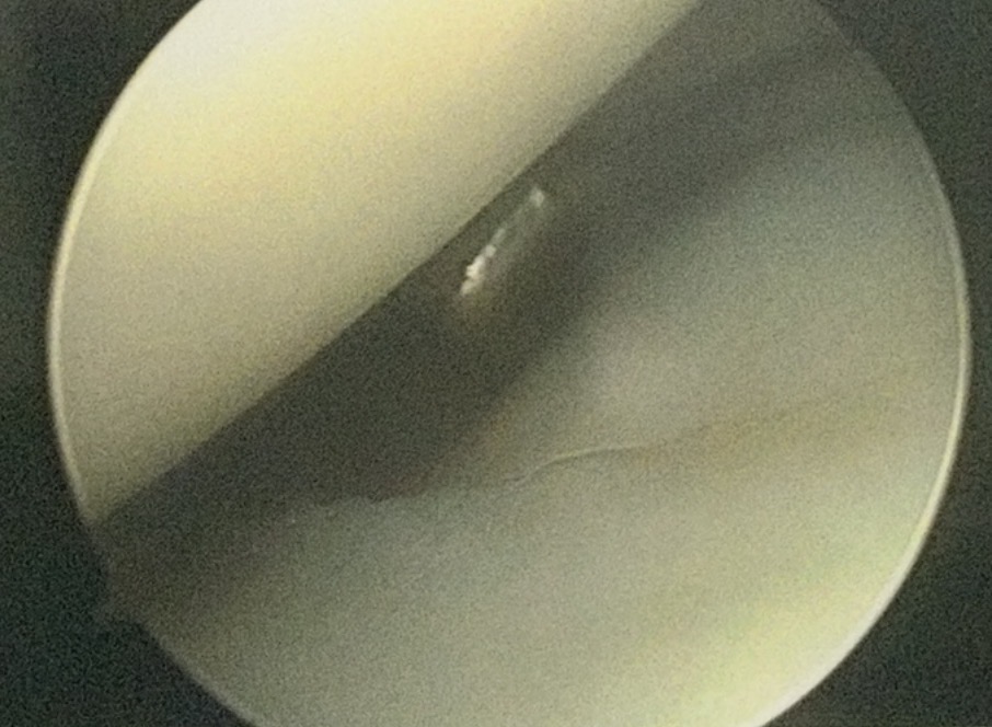Arthroscopic view inside a knee joint