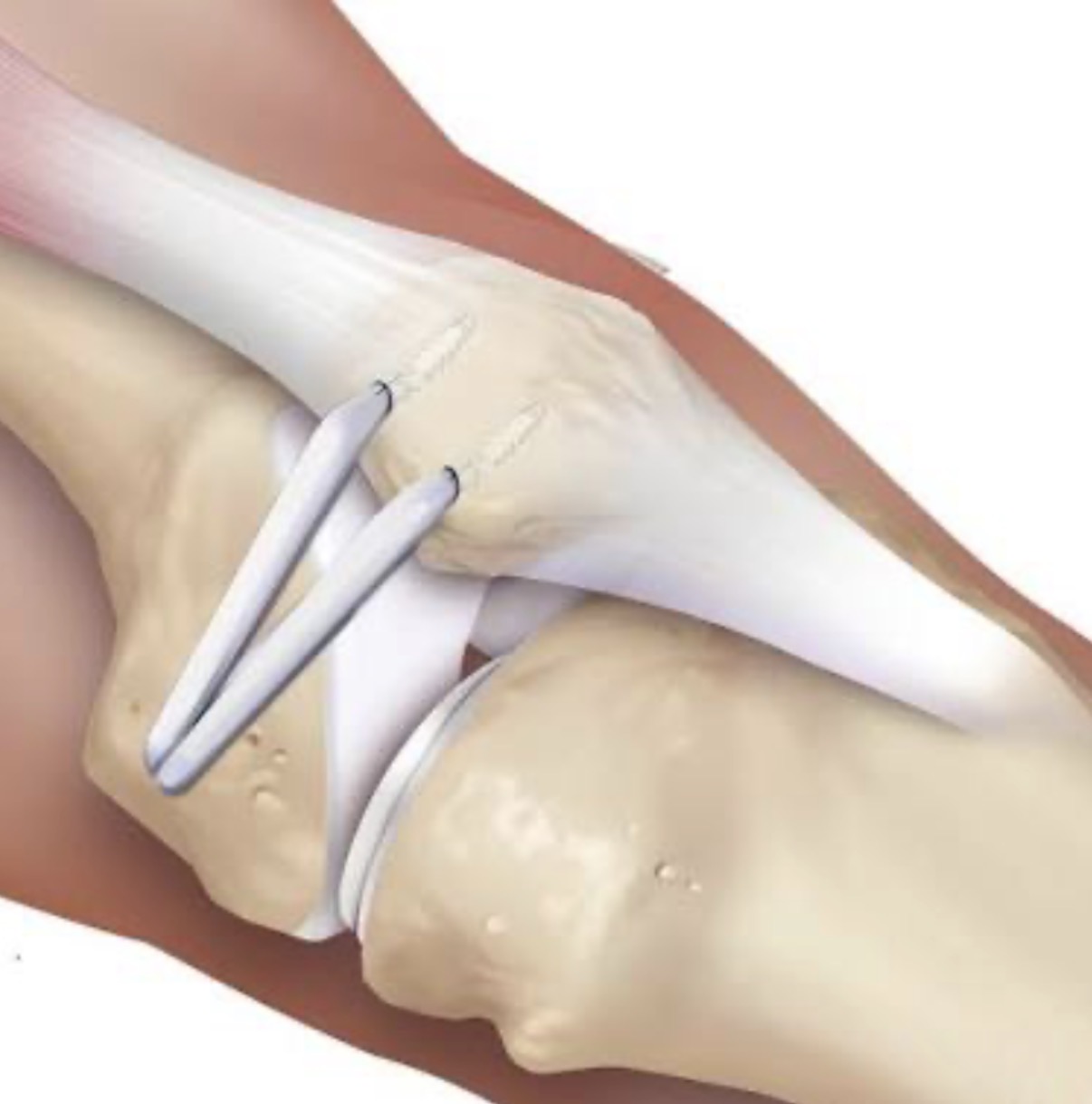 Anatomical diagram of MPFL reconstruction showing two suture anchor fixation points on the medial patella
