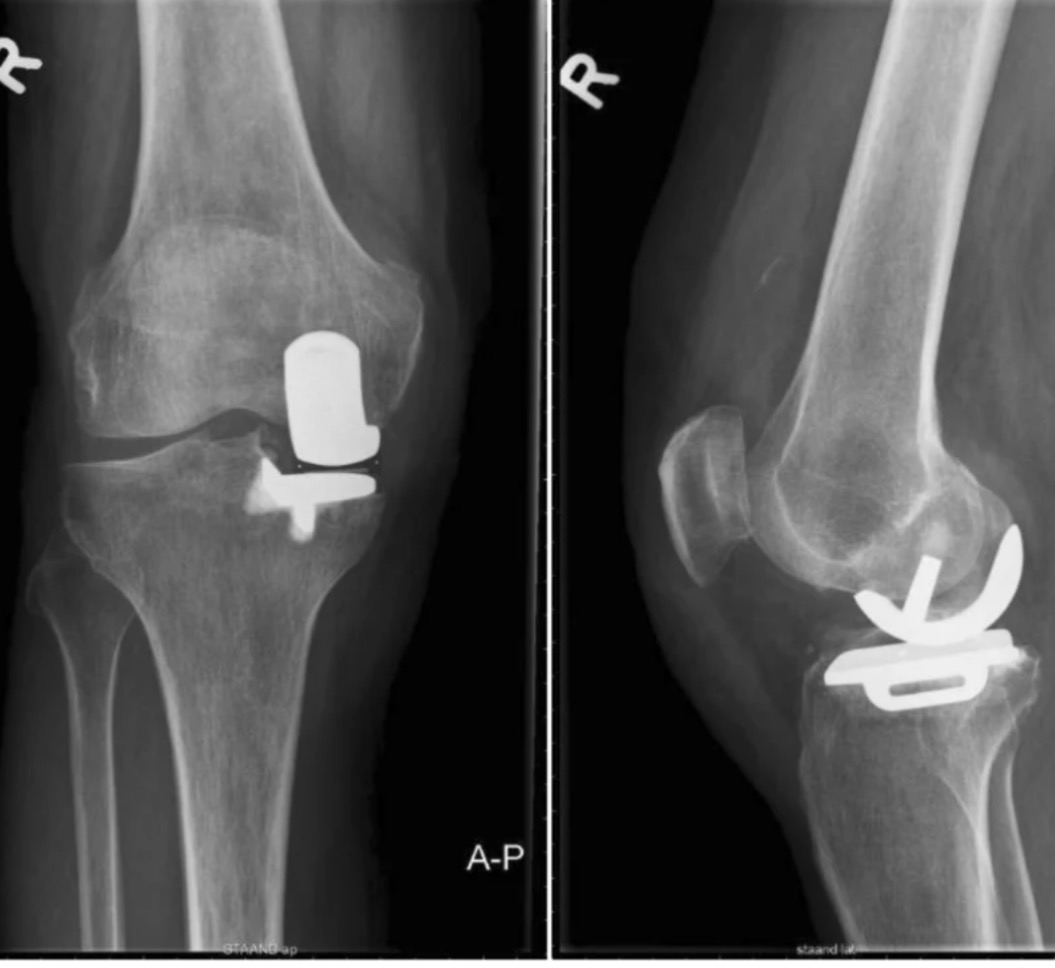 X-ray of a partial knee replacement (A-P and lateral views)